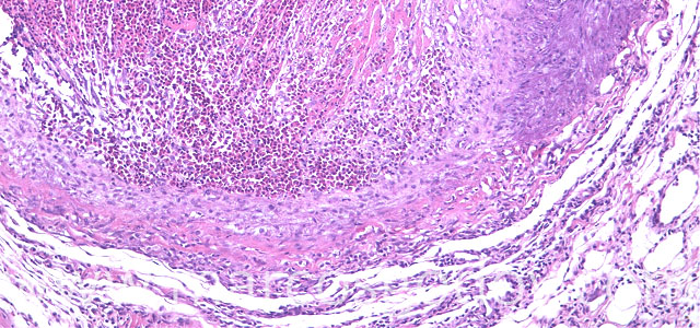 Trombosis 100X III