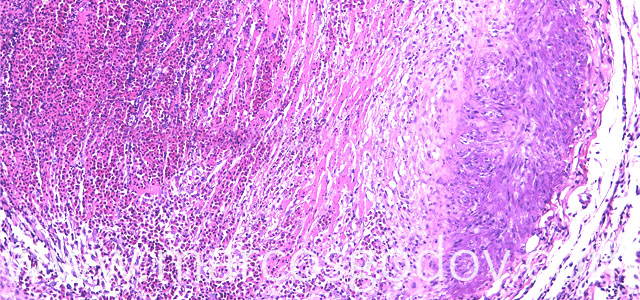 Trombosis 100X II copia