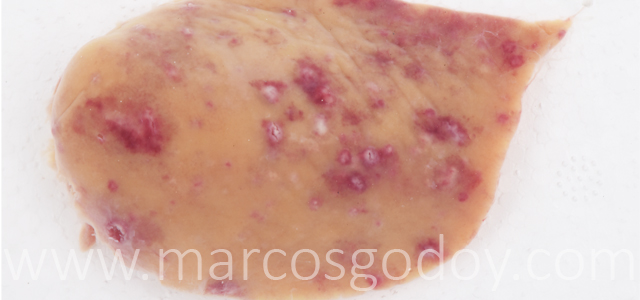 Hepatitis granulomatosa IX