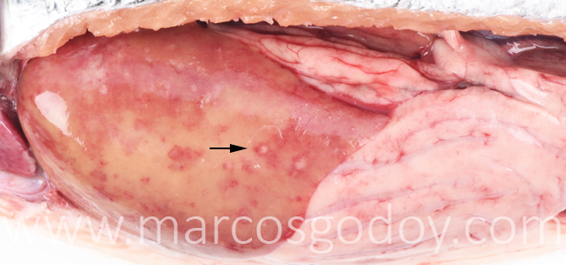 Hepatitis granulomatosa V