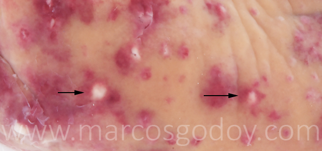 Hepatitis granulomatosa VIII
