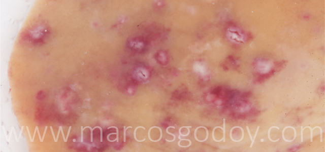 Hepatitis granulomatosa X