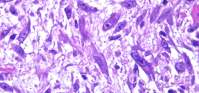 Fibrosarcoma 630X I