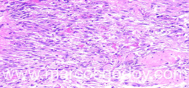 Firbosarcoma 100X VIII copia