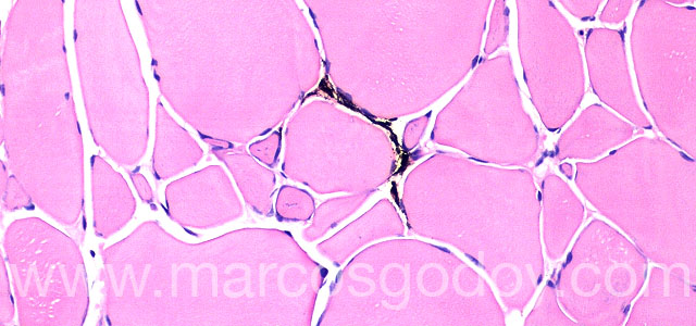 Melanosis necrositante 20X I