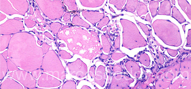 Melanosis necrositante 20X IV