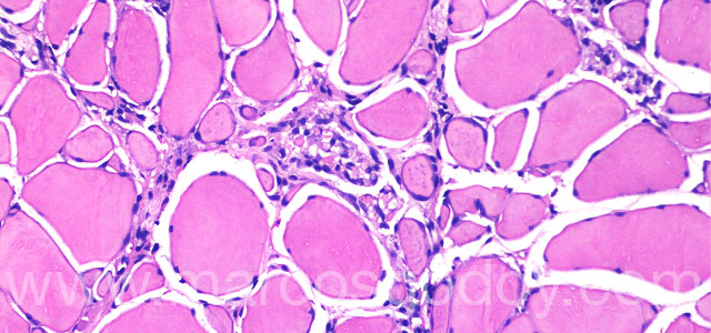 Melanosis necrositante 20X V