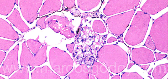 Melanosis necrositante 20X VII