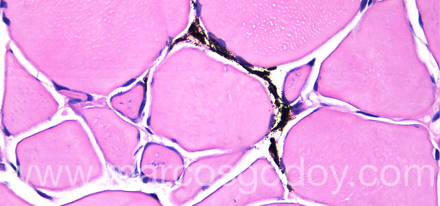 Melanosis necrositante 40X III