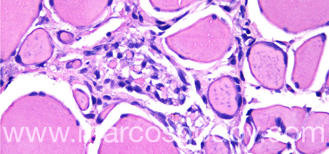 Melanosis necrositante 40X IX