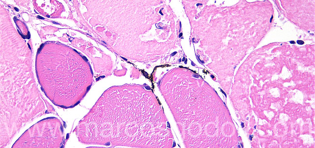 Melanosis necrositante 40X VIII