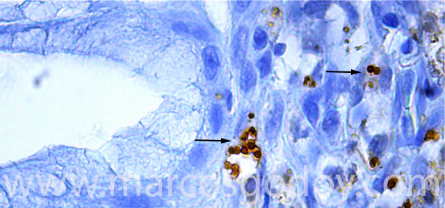 Gastritis IHQ Ps 1000 VII