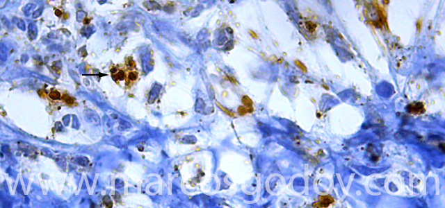 Gastritis IHQ Ps 1000 X