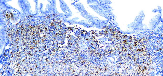 Gastritis IHQ Ps 100X