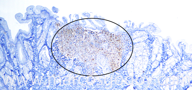 Gastritis IHQ Ps 40X