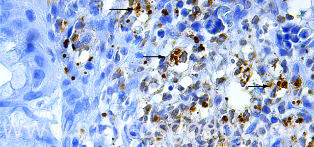 Gastritis IHQ Ps 630 V