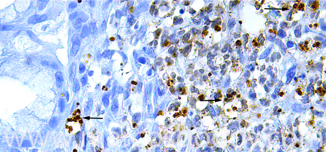 Gastritis IHQ Ps 630 VI