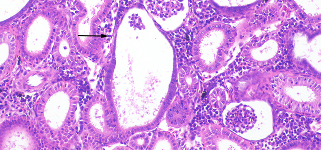 Glomerulocysticdiseas 200X IX