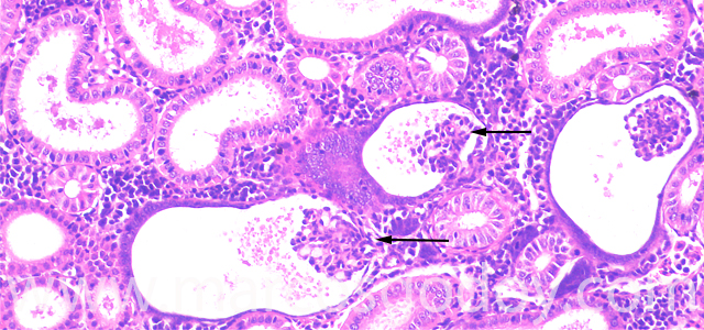 Glomerulocysticdiseas 200X VI