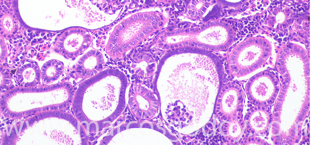 Glomerulocysticdiseas 200X VII