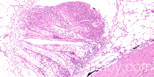 Trombosis hipodermis 100X III