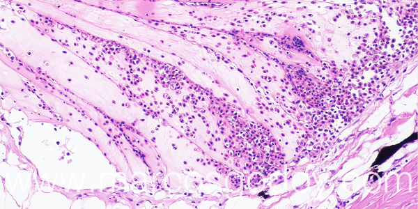 Trombosis hipodermis 200X IV
