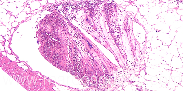 Trombosis hipodermis 40X I