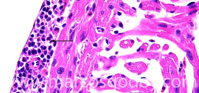 Epicarditis 400X IVjpg