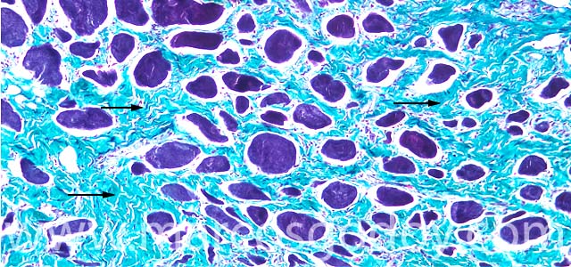 Muscle fibrosis 100X I