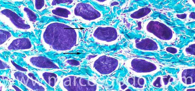 Muscle fibrosis 200X II