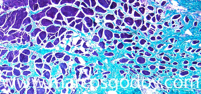 Muscle fibrosis 40X III