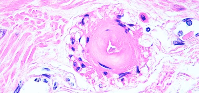 Estomago hyaline 630X V