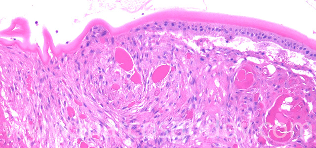 Cristalino cataract 63X IX