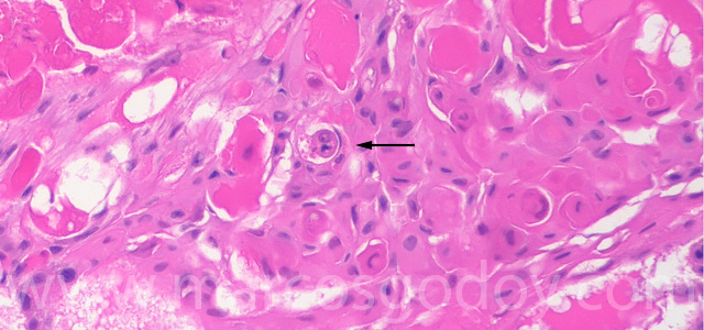 Cristalino cataract 63X VIII