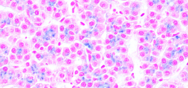 Hepatic hemosiderosis III