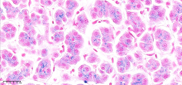 Hepatic hemosiderosis IX