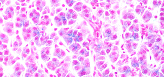Hepatic hemosiderosis V