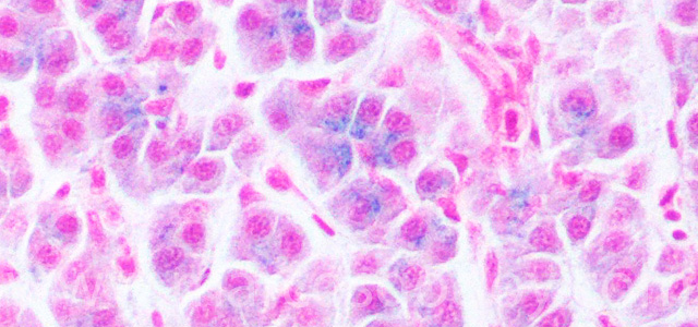 Hepatic hemosiderosis VI