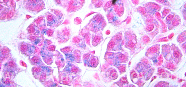 Hepatic hemosiderosis VII