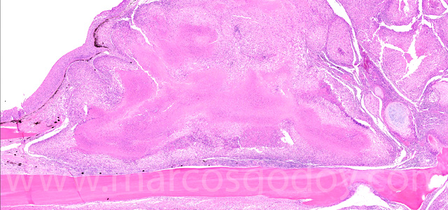 Dermatisis articular III