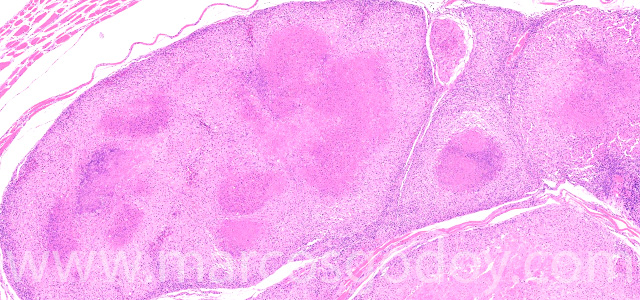 Dermatisis articular VI
