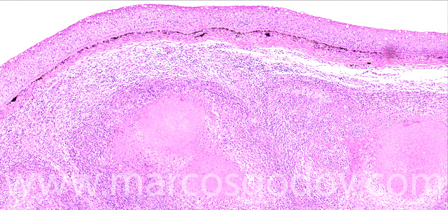 Dermatisis articular Vjpg