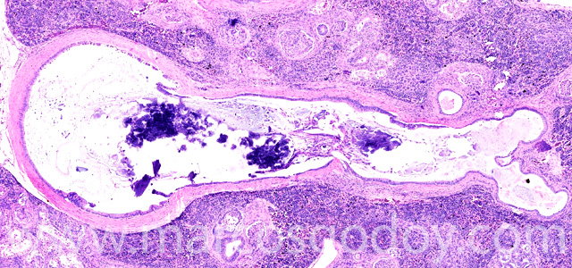 Calcinosis renal II