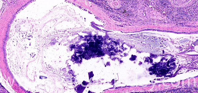 Calcinosis renal III