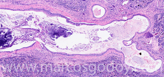Calcinosis renal IV