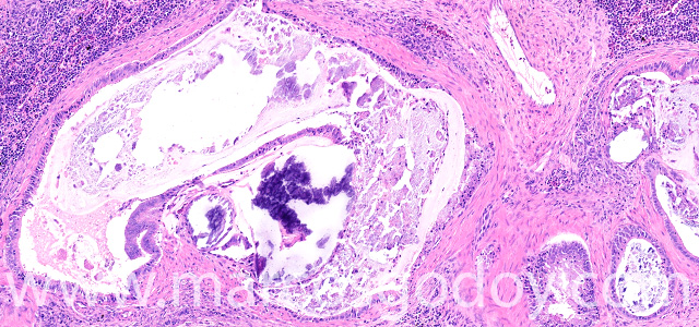 Calcinosis renal IX