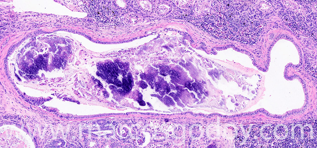 Calcinosis renal V