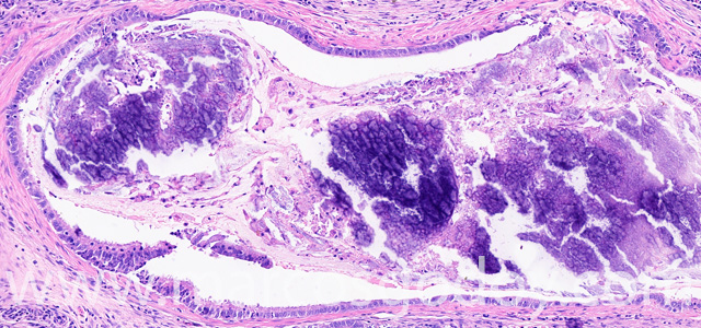Calcinosis renal VI