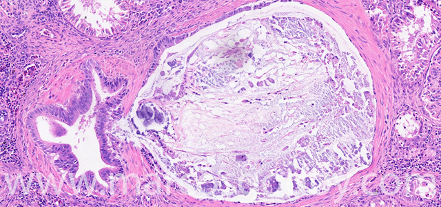Calcinosis renal VII