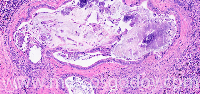 Calcinosis renal VIII